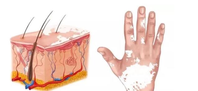 手指关节出现白斑图片