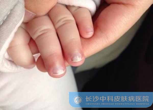 长沙儿童白癜风医院：宝宝缺锌指甲白斑图片