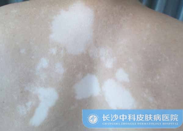 背部白癜风扩散