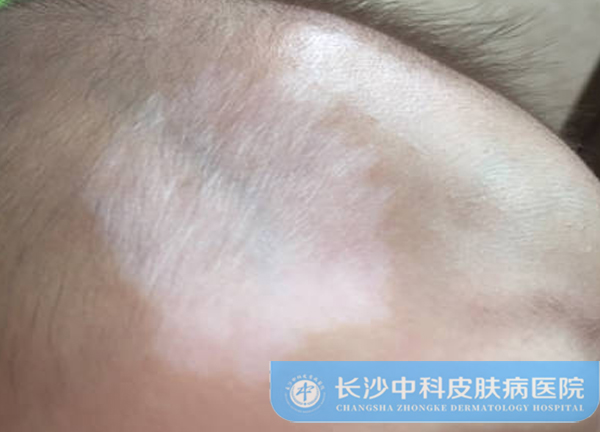 白斑扩散