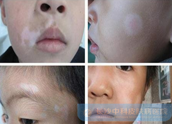 小孩患上白斑病