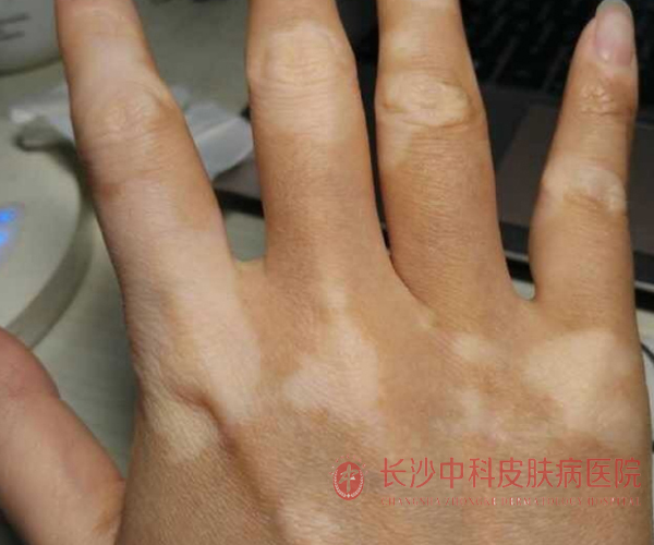手指关甲发白